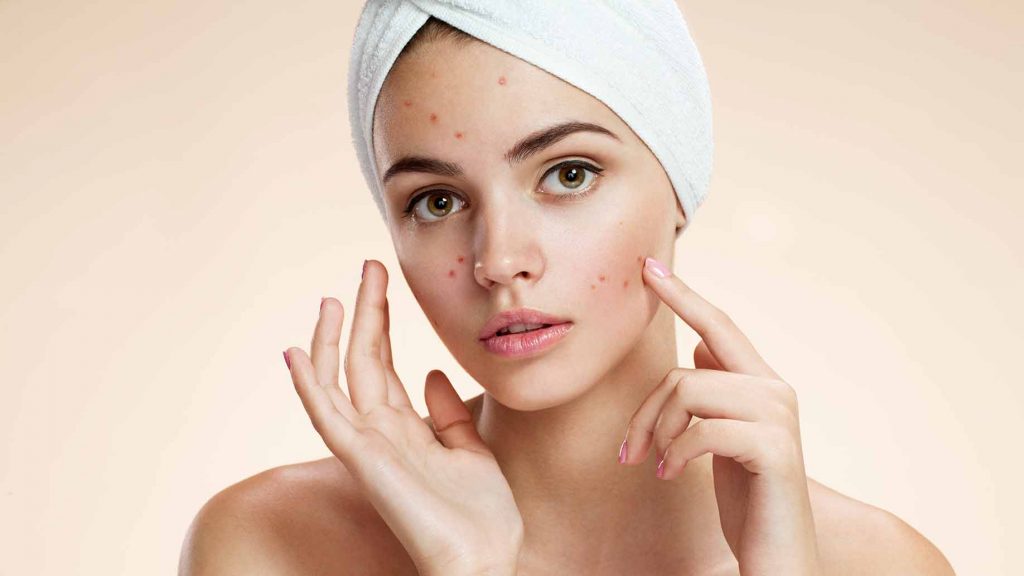 Natural acne solution